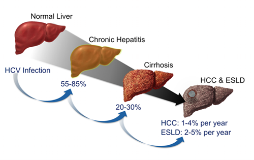 Điều Trị Viêm Gan Siêu Vi C Mạn Tính Ở Trẻ Em 